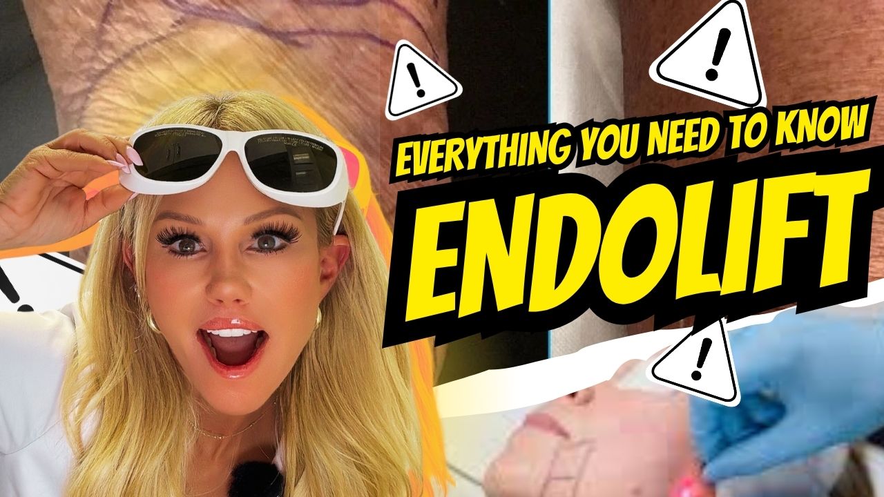 What Is Endolift?